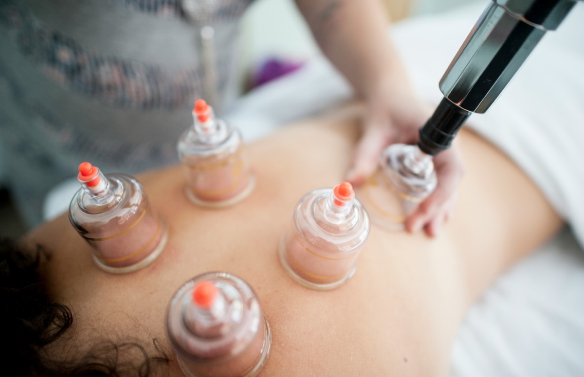 Cupping Therapy at SOMA Healing Spa